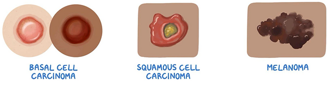  Types of skin cancer cells